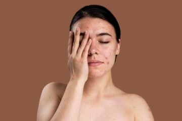 Microneedling for acne scars