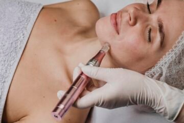 Microneedling treatment